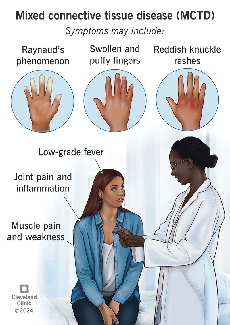 MCTD Symptoms: Raynaud's, swollen fingers, rashes, pain