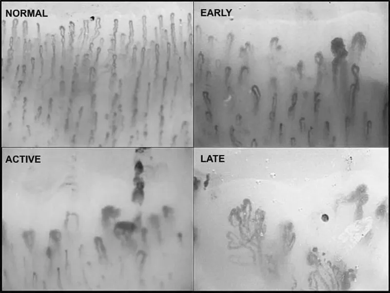 Nailfold capillaroscopy patterns in SSc