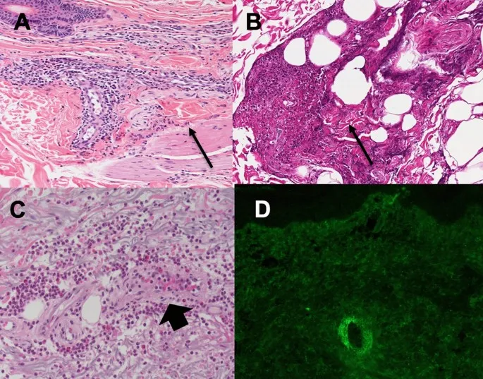 Leukocytoclastic vasculitis skin biopsy