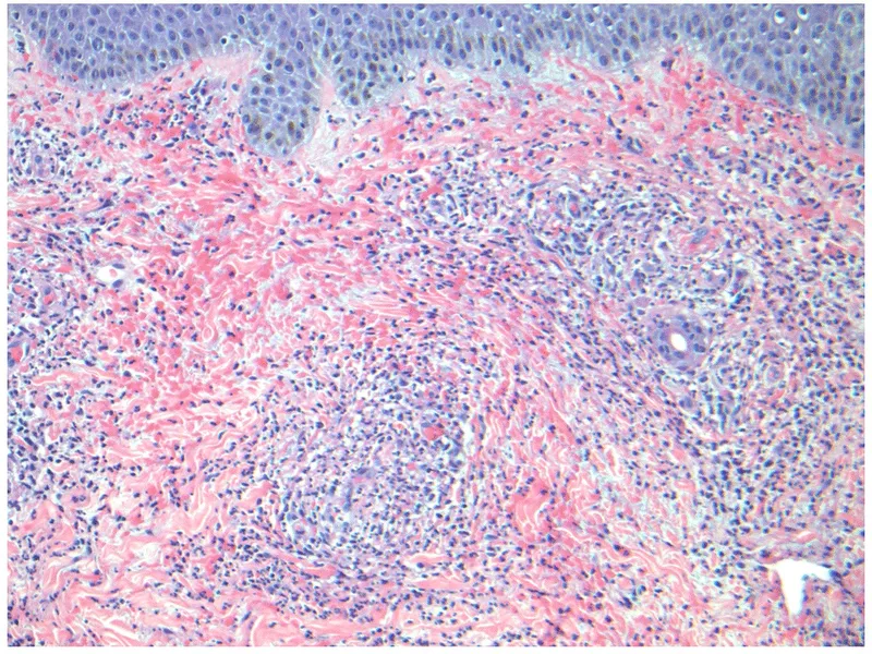 Histopathology of Leukocytoclastic Vasculitis