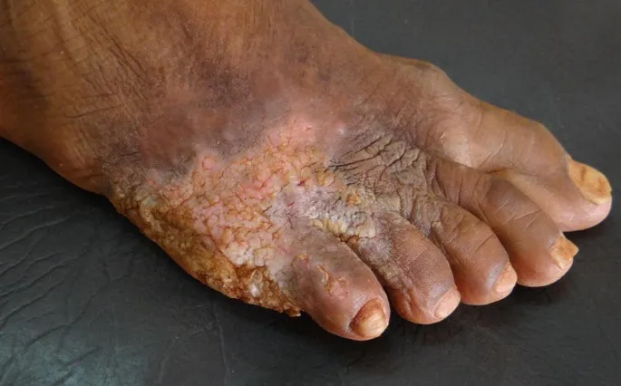 Tuberculosis Verrucosa Cutis on foot