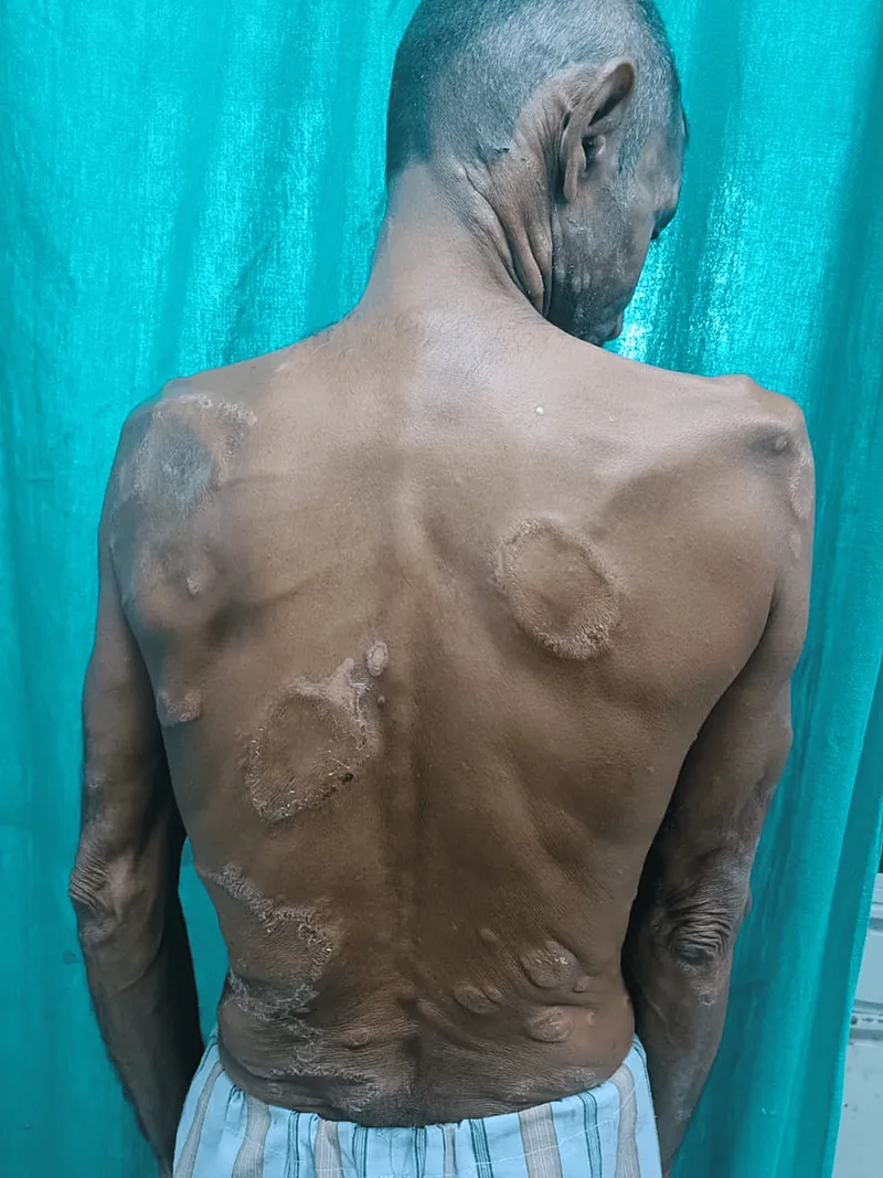 Leprosy Classification Diagram