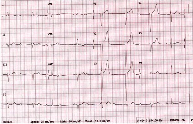 ECG showing AV block in Lyme carditis