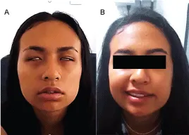 Bilateral facial nerve palsy in Lyme disease