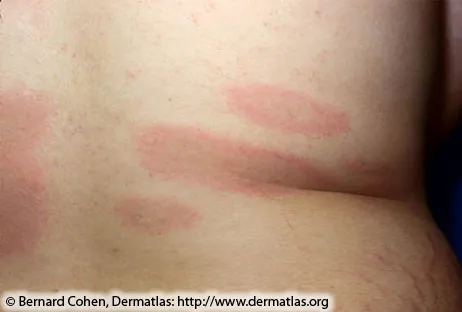 Multiple Erythema Migrans Lesions