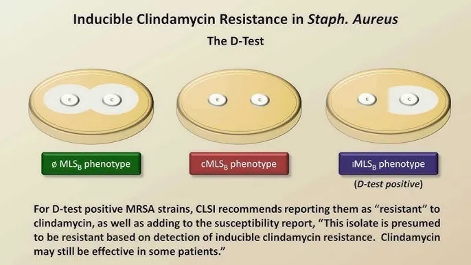 D-test for inducible clindamycin resistance in Staph. aureus