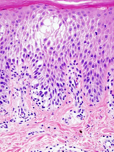 Histopathology of spongiosis in epidermis