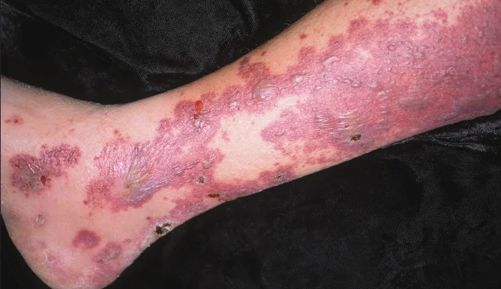 Palpable purpura and bullae in leukocytoclastic vasculitis