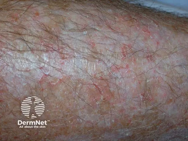Asteatotic eczema craquelé on elderly leg