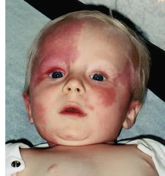 Infant with port-wine stain in V1 trigeminal distribution