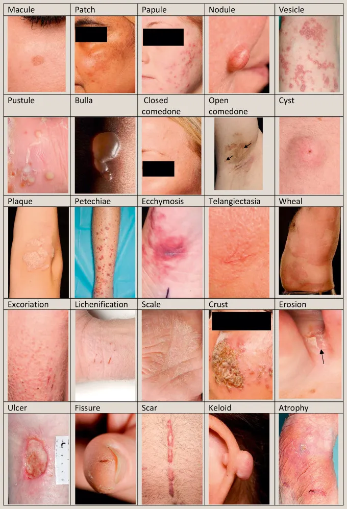 Primary and Secondary Skin Lesions