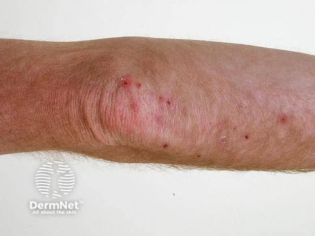 Dermatitis Herpetiformis on Elbow