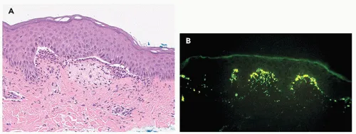 Dermatitis Herpetiformis H&E and DIF