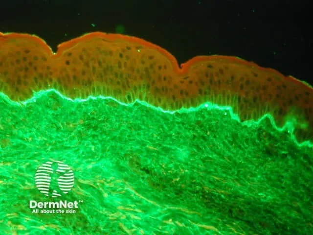 Linear IgA deposits in LABD