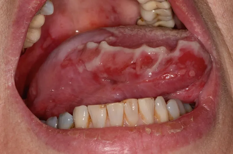 Intraoral Pemphigus Vulgaris