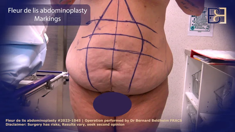 Fleur de lis abdominoplasty markings
