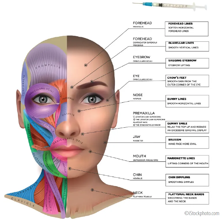 Facial muscles and botulinum toxin injection sites