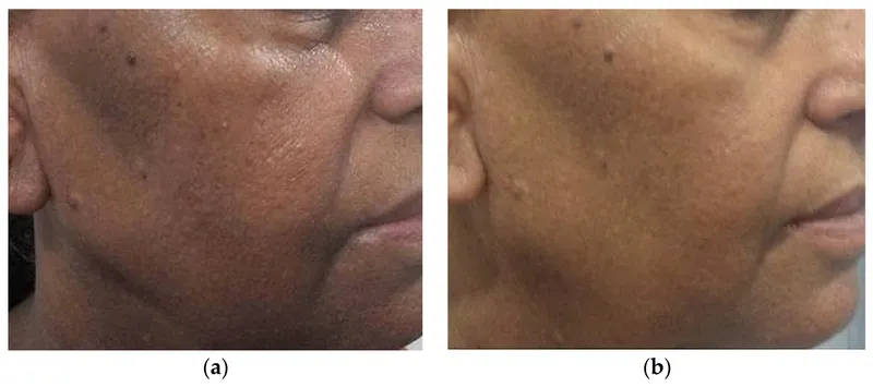 PIH after laser treatment in darker skin