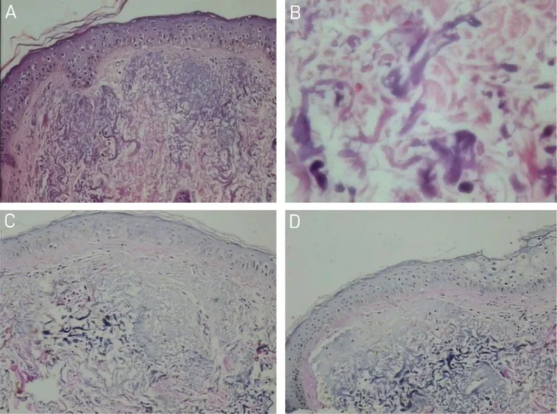 Histopathology of solar elastosis