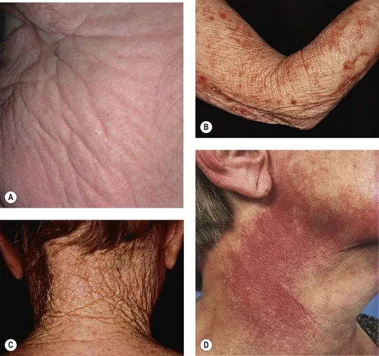 Clinical signs of photoaging