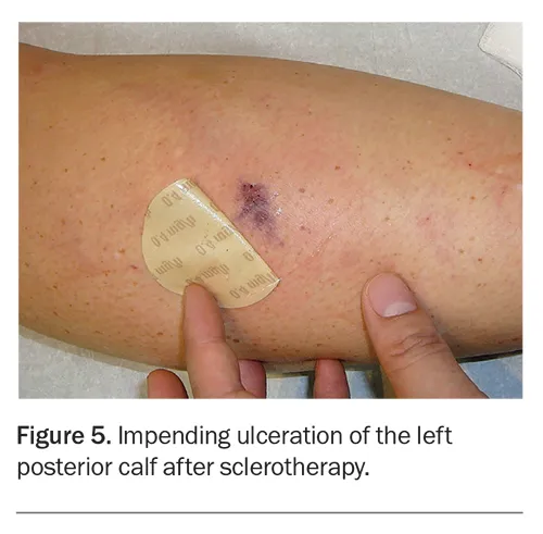 Impending ulceration after sclerotherapy