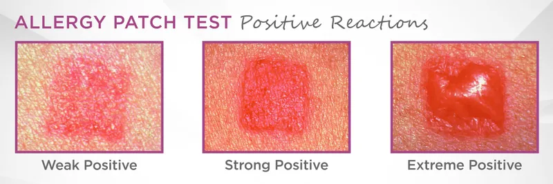 Allergy Patch Test Positive Reactions