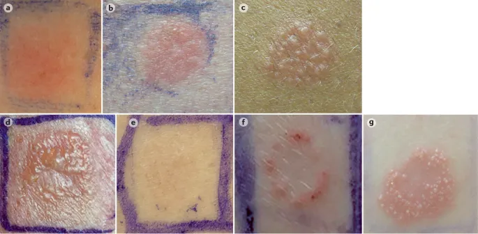 Patch test reactions in allergic contact dermatitis