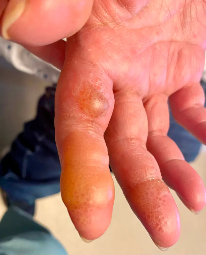Dyshidrotic eczema with tapioca-like vesicles
