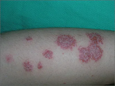 Nummular eczema lesions