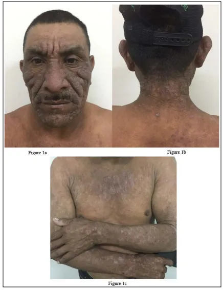 Chronic Actinic Dermatitis on sun-exposed skin