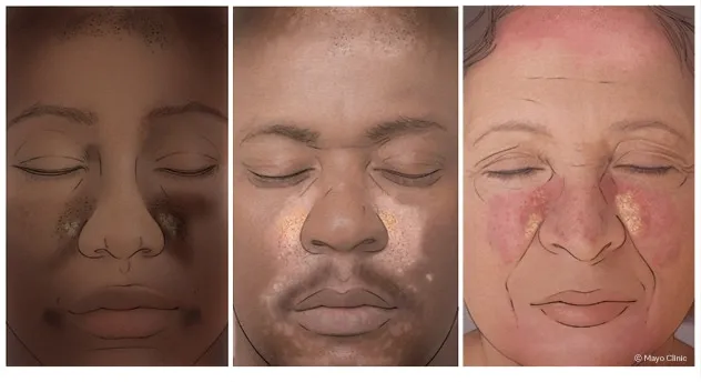 Seborrheic dermatitis on face across different skin tones