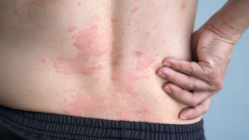 Urticaria (Hives)