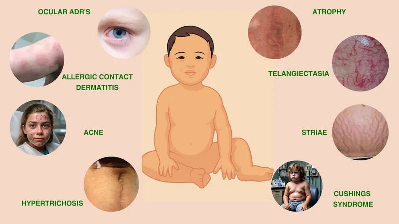 Side effects of topical corticosteroids