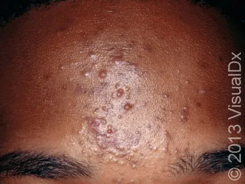 Acne vulgaris lesions on forehead
