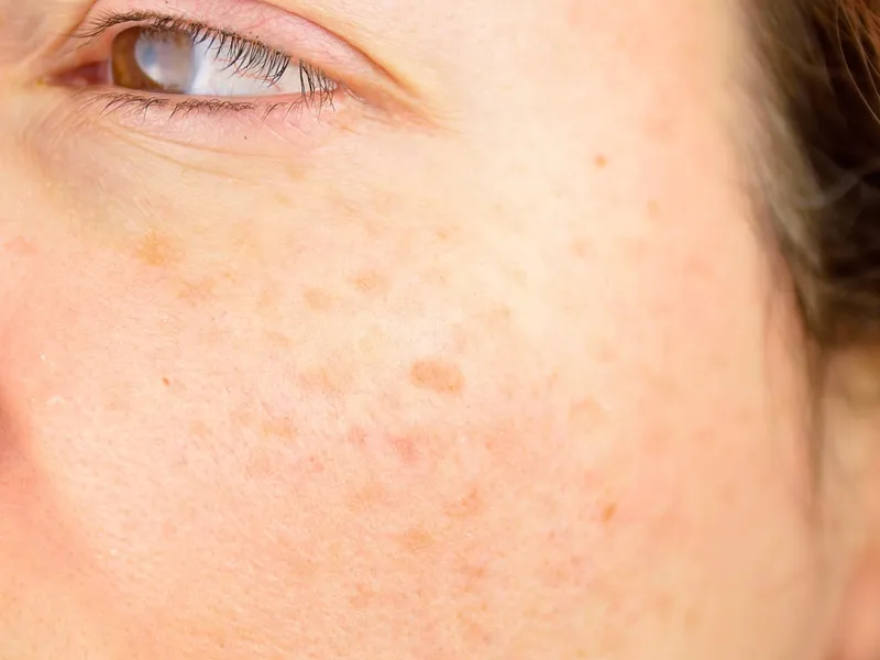 Signs of photoaging: fine lines and solar lentigines