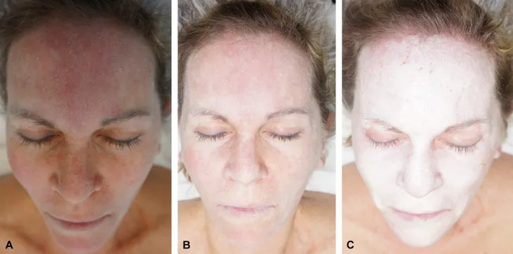 TCA Chemical Peel Frosting Endpoint