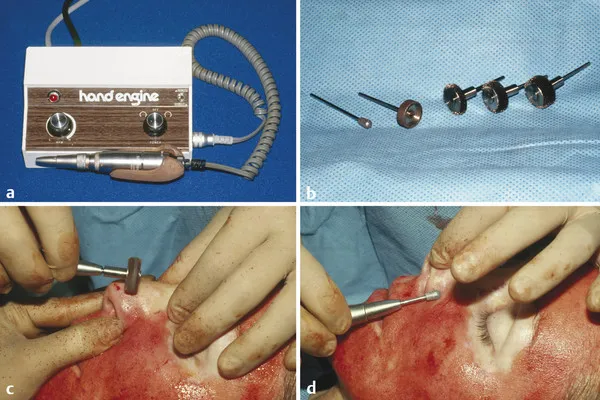 Dermabrasion equipment and procedure