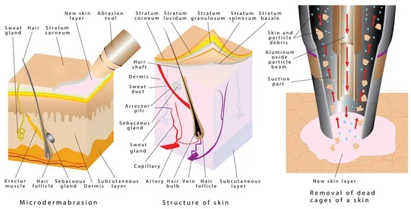 Dermabrasion vs Microdermabrasion: Skin Layers Affected