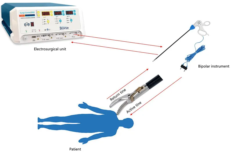 Monopolar vs Bipolar Electrosurgery Circuits