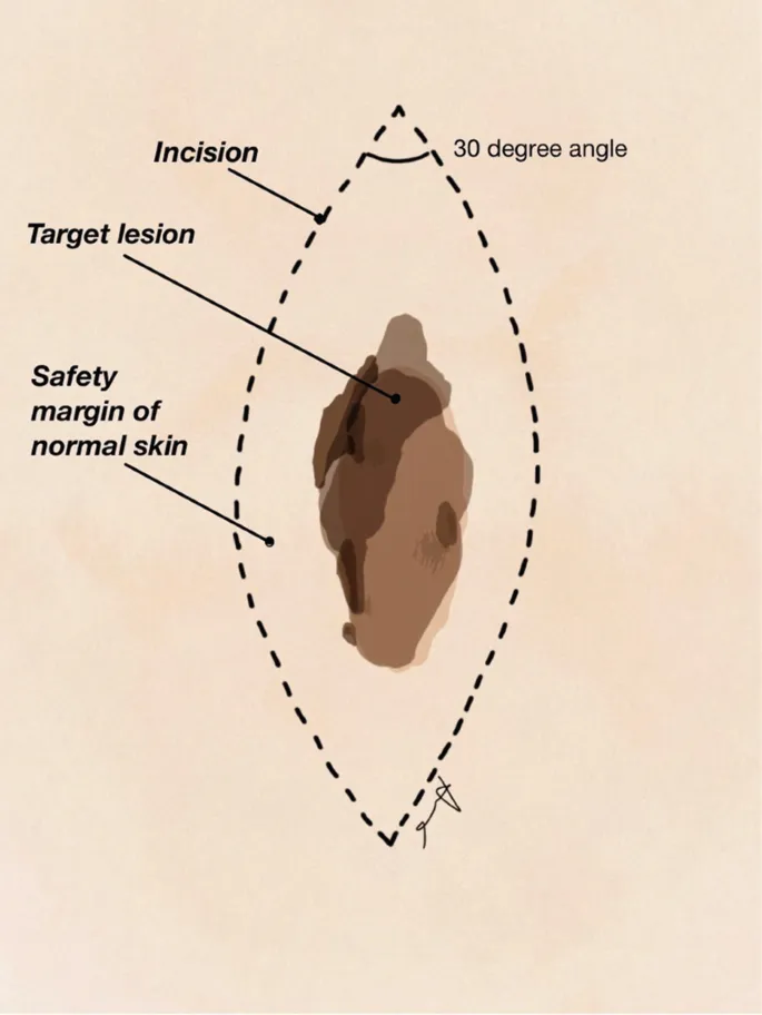 Ideal elliptical excision diagram