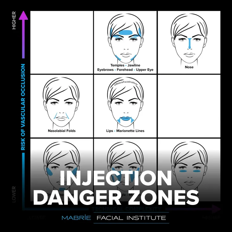 Facial Injection Danger Zones and Vascular Occlusion Risk