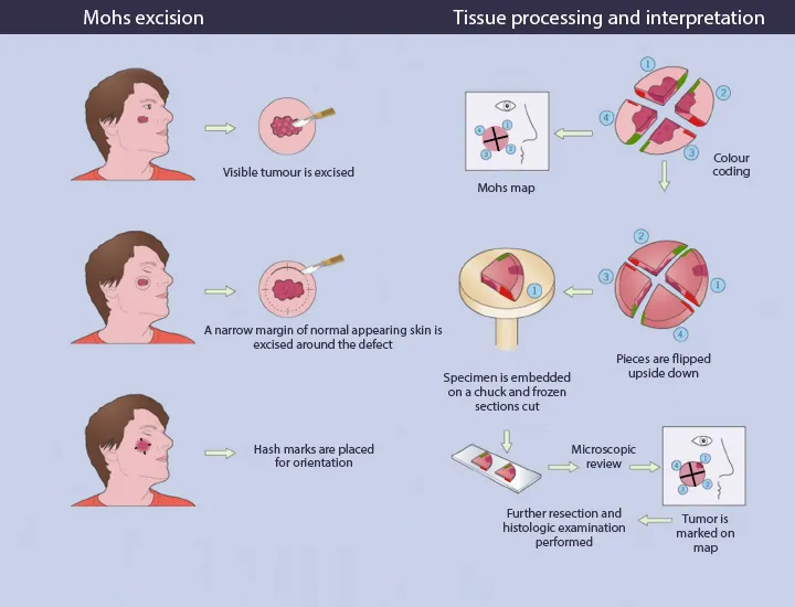 Mohs surgery steps: excision, mapping, processing, review