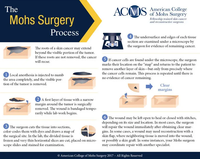 Mohs Surgery Process Diagram
