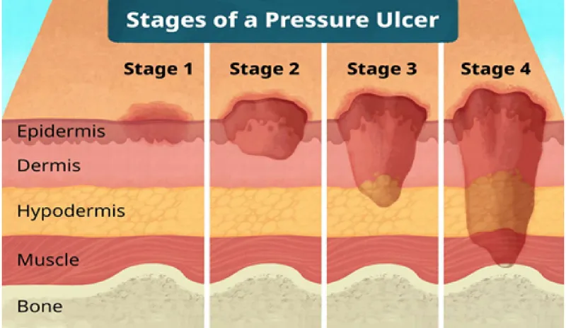 Stages of a Pressure Ulcer