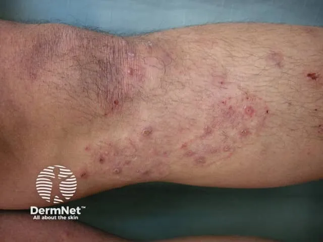 Majocchi's granuloma