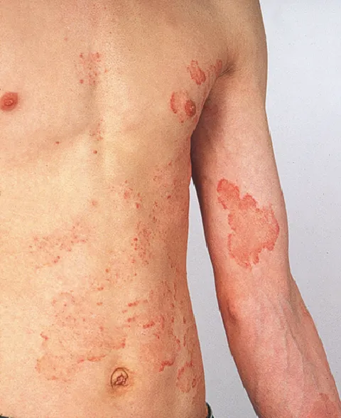 Tinea corporis lesions on torso and arm