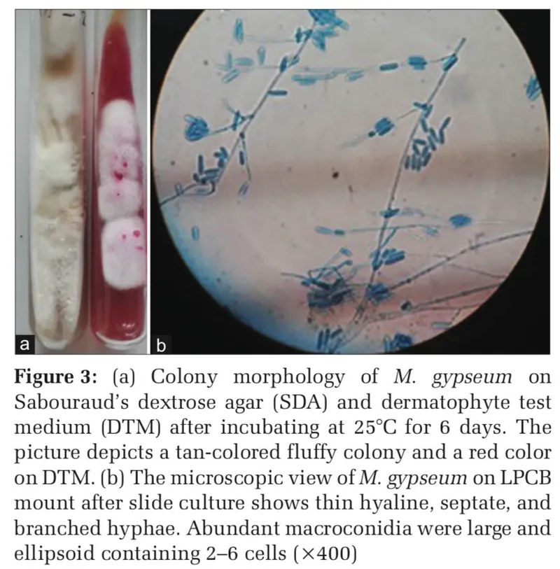 M. gypseum culture on SDA/DTM and microscopic view
