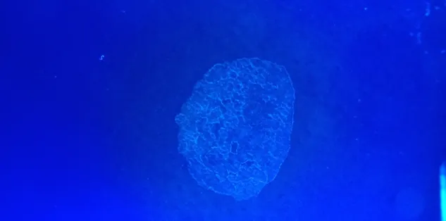 Wood's lamp fluorescence of Pityriasis versicolor