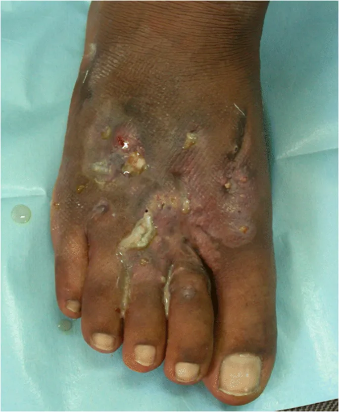 Mycetoma foot with sinuses and grains
