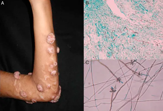 Chromoblastomycosis: clinical, histology, culture
